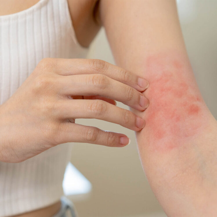 درماتیت یا التهاب پوست چیست؟